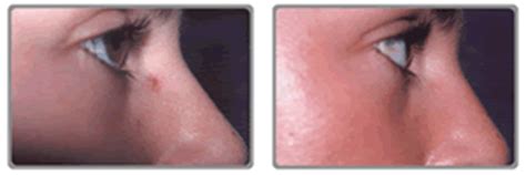 Cherry angioma is the most common type of angioma. Botox Treatment Mansfield