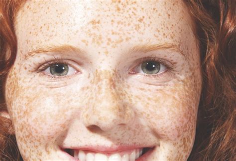Types Of Freckles Chart