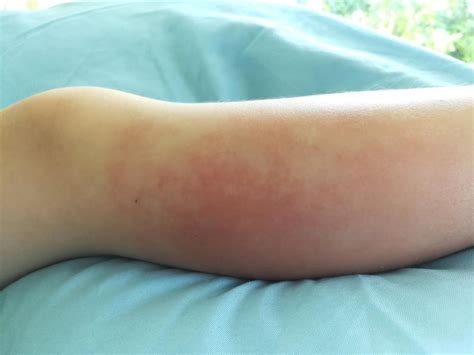 What Is Cellulitis And How Can I Avoid It Avisheh Forouzesh Md