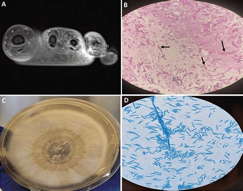 Cureus Fusarium Solani Necrotizing Fasciitis Complicating Treatment