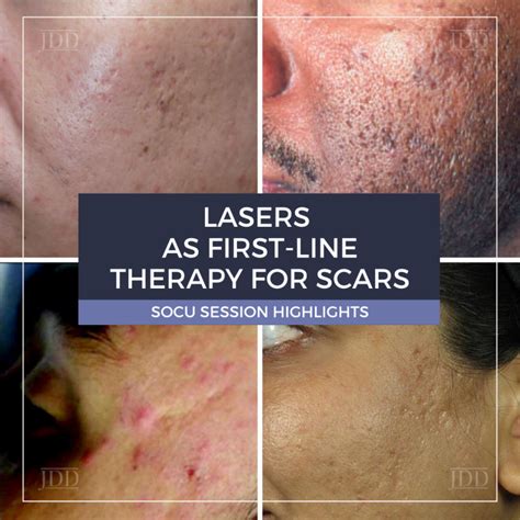 Lasers As First Line Therapy For Scars Next Steps In Dermatology