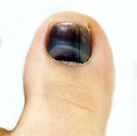 Why Has My Toenail Turned Black The Chiropody Clinic Enfield