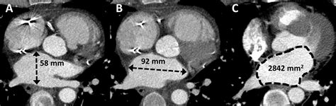 Going Beyond Cardiomegaly Evaluation Of Cardiac Chamber Enlargement At