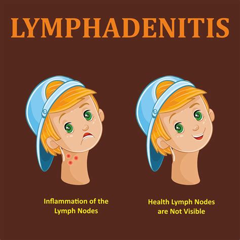 Lymph Nodes In Children Doctorvisit