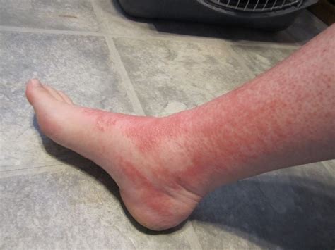 Red Bumps On Ankles Pictures Photos