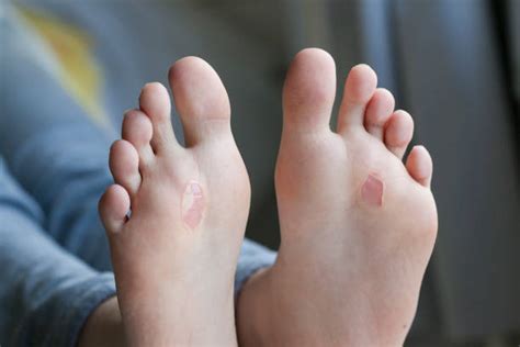 How Long Does It Take For A Blister To Heal And Why How To Prevent