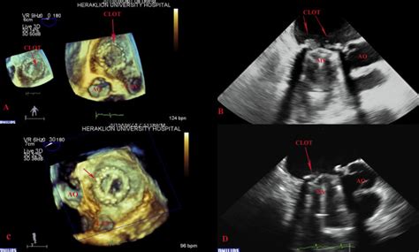 Prosthetic Mitral Valve Thrombosis During Pregnancy Treated