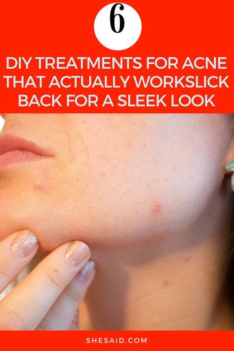 6 Diy Treatments For Acne That Actually Work Cystic Acne Treatment