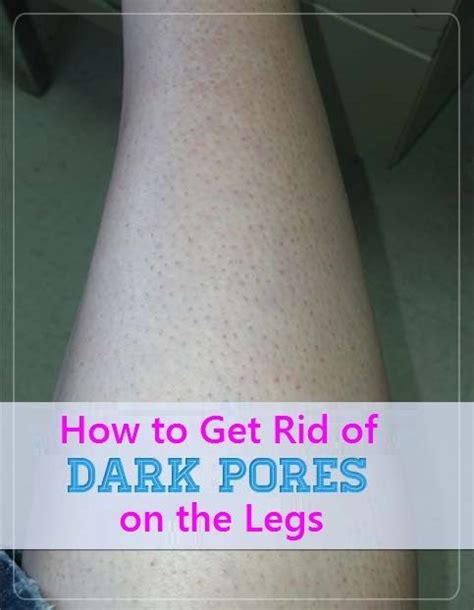 How To Get Rid Of Dark Pores On The Legs Dark Pores Beauty Remedies