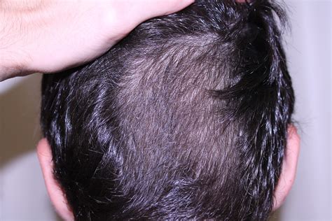 dermatologo valencia se me cae el pelo tratamientos para la caída de cabello ¿por qué me cae