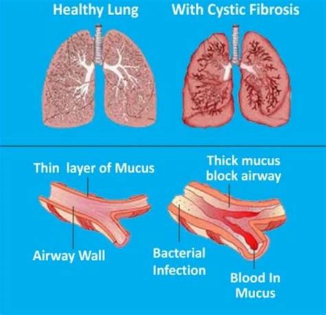 Cystic Fibrosis Lungs Vs Healthy Lungs