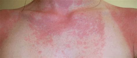 Sun Allergy Rash Types Hives Causes Symptoms Pictures Prevention