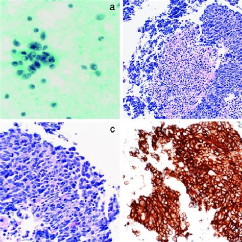 Cytologicalhistological Diagnosis Of Large Cell Neuroendocrine