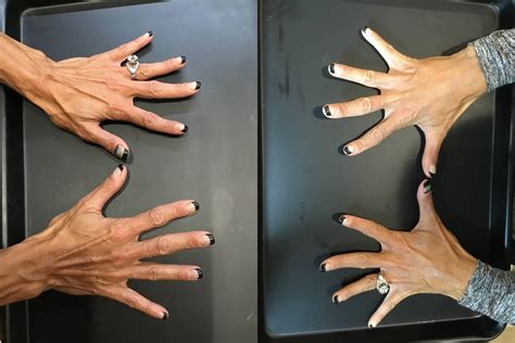 Hand Rejuvenation Evansville | Best Radiesse Treatments in Evansville