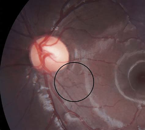 Corkscrew Retinal Vessels The Anomaly Consisted Of Minuscule Second Or
