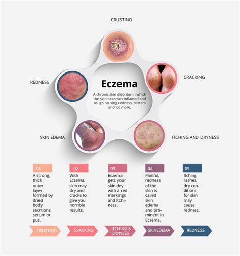 What Actually Is This Eczema A Simple Answer To This Question That We