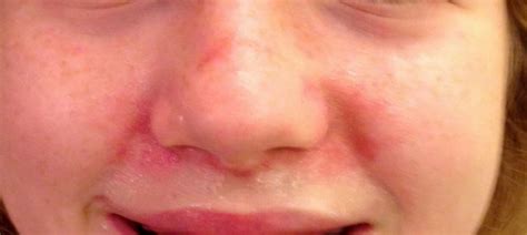 Redness Around Nose Cheeks Mouth Causes Pictures Get Rid Toddler