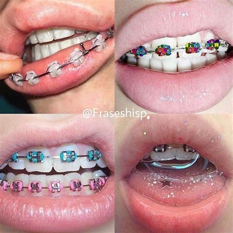 aparelho tumblr dental braces teeth braces dental care permanent retainer piercing