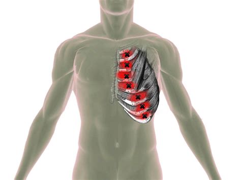 Rib Cage Muscles Upper Back Pain From Intercostal Muscle Strain