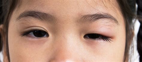 How To Reduce Swollen Eyelids Step By Step Guide