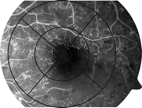 Efficacy Of Ranibizumab In Eyes With Diabetic Macular Edema And Macular