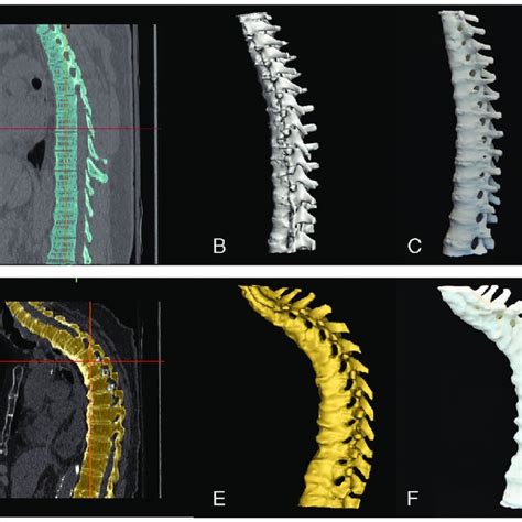 Normal Thoracic Spine Processing Ct Scan Of A Normal Thoracic Spine