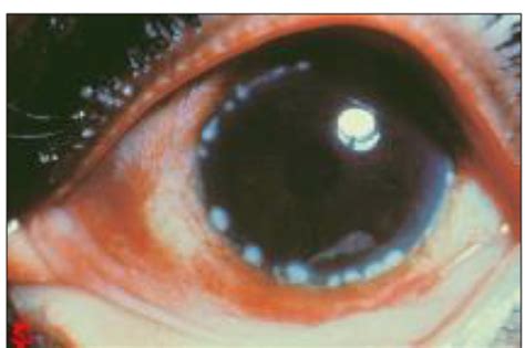 Ocular Disease Exam 2 Flashcards Quizlet