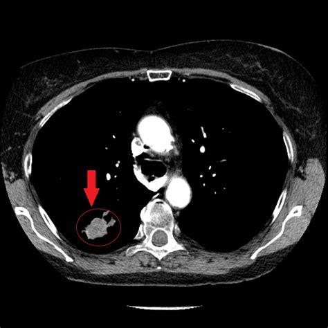 Adenocarcinoma Of The Lung Ct Wikidoc