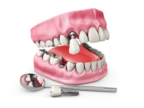 What Are The Signs Of Dental Implant Failure