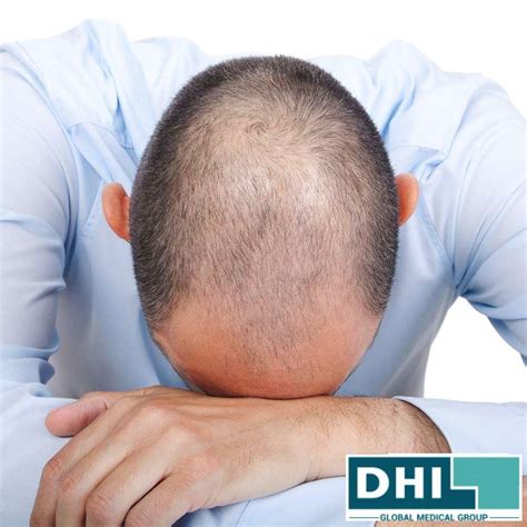 Going Bald Too Young Top Tips From The Hair Loss Experts Dhi Global Medical Group