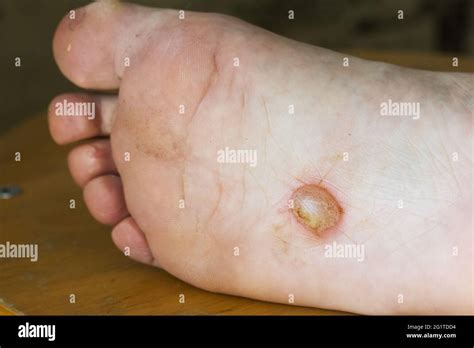 Dyshidrotic Eczema On The Foot Blister Dermatitis Close Up Shot Stock