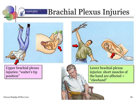 Brachial Plexus