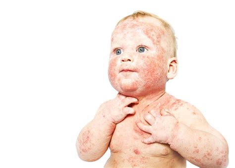 Atopic Dermatitis And The Atopic March
