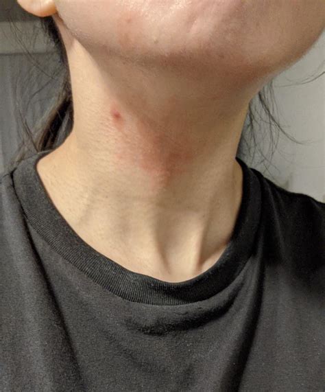 Redness And Itch Or Possibly Rash On Neck Started Happening Just