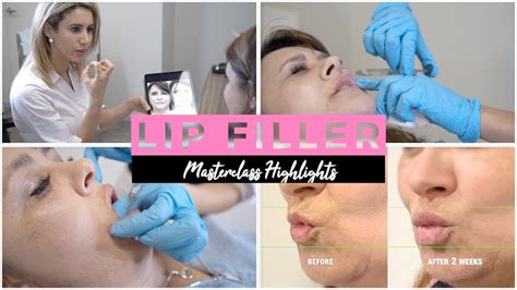 Advanced Lip Filler Techniques Tutorial With Dr Nora Highlights Youtube