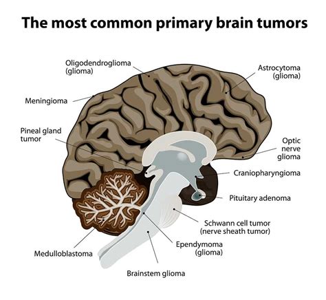 13 Types Of Brain Tumors Scientific Images Left Side Pains