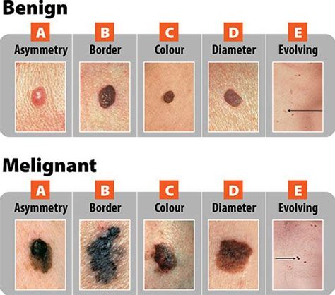 Asymmetric Moles And Melanoma Detailed Guidelines Scary Symptoms