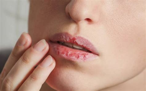 What Are The Main Causes Of Dry Lips Best Herbal Health