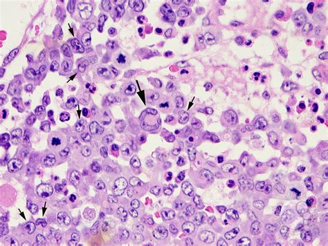 Anaplastic Large Cell Lymphoma Involving The Bone Marrow 4