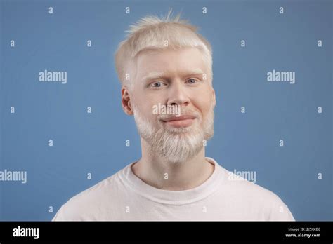 Skin Abnormality Concept Portrait Of Bearded Handsome Albino Guy