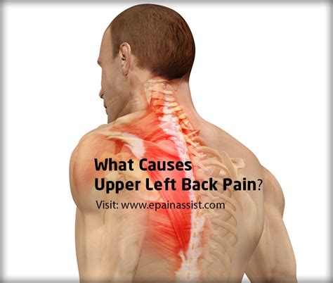 Upper Left Back Paincausessymptomstreatmentdiagnosis