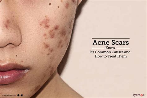 Acne Scars Know Its Common Causes And How To Treat Them By Dr