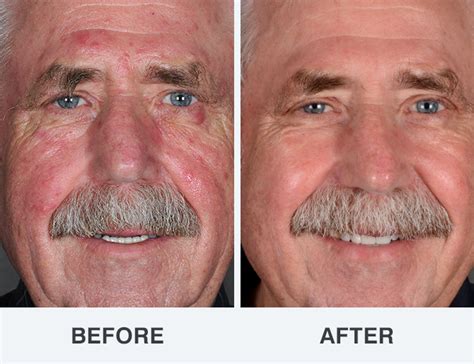 Rosacea Treatment Photos Soderstrom Skin Institute