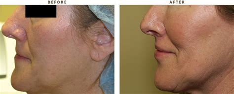 Lip Lift Before And After Pictures Dr Turowski Plastic Surgery