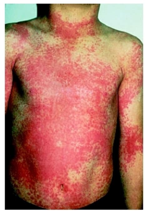 Scarlet Fever Or Scarletina An Infectious Bacterial Disease Similar