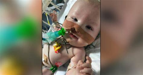 Baby Boy With No Jaw Undergoes Facial Operation Thats 1st Of Its Kind
