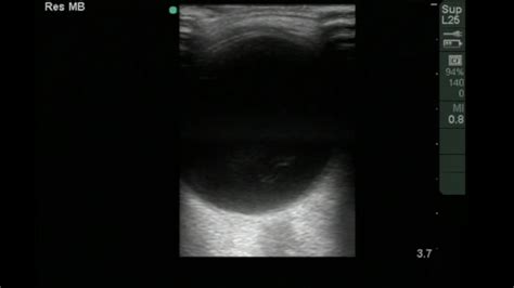 Ocular Ultrasound Vitreous Hemorrhage Youtube