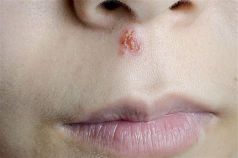 Cold Sore On Lower Lip