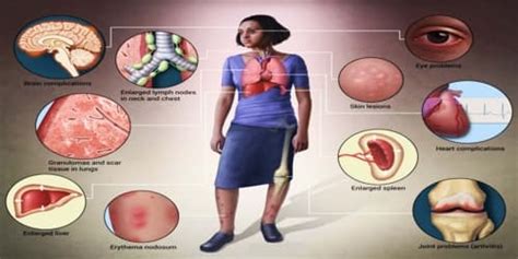 Sarcoidosis Symptoms Diagnosis And Treatment Assignment Point