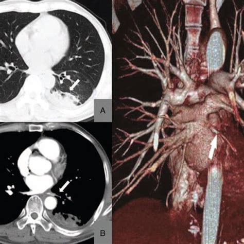 Pulmonary Angiography For Pulmonary Vein Stenosis Pvs Patient A